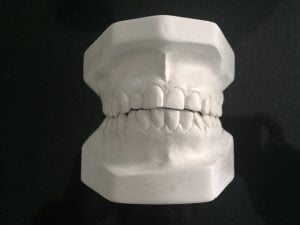 Modelos de yeso de los dos maxilares