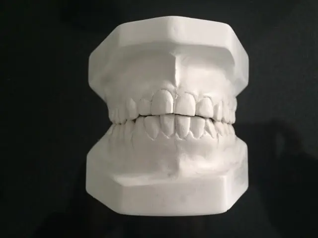 cierre de espacios en ortodoncia