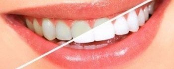 Blanqueamiento dental en Turquía