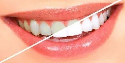 Blanqueamiento dental en Turquía