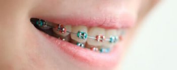 colored braces