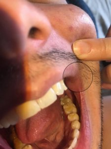 queilitis angular