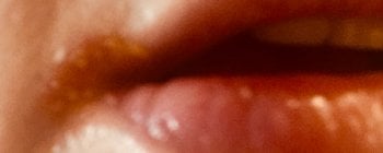 Queilitis angular o boqueras, inflamación de la mucosa de la comisura labial