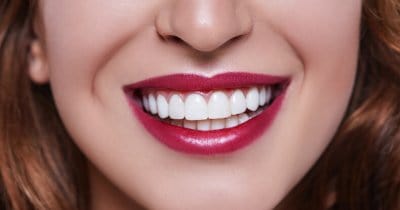 veneers smile