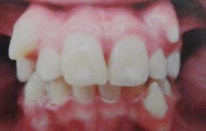 Maloclusión dental caracterizada por falta de espacio