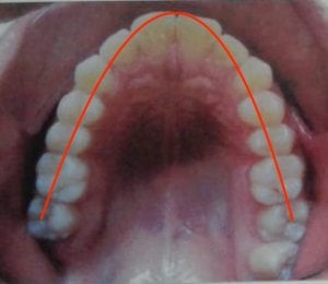 Alineación dental, los dientes se ubican formando un arco, en la posición adecuada