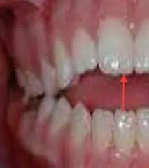 Maloclusión vertical por falta de contacto entre los dientes superiores e inferiores