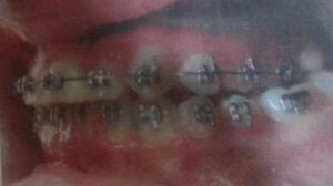 Mordida cruzada lateral unilateral, de algunos dientes posteriores