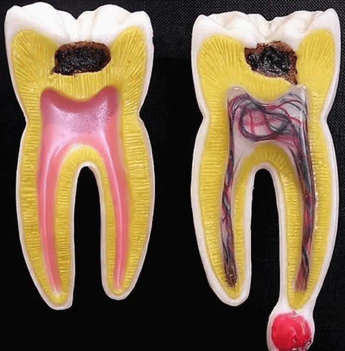 pulpitis: imagen de patología pulpar