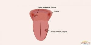 Tumores en la lengua