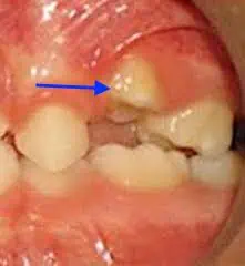 anquilosis dental