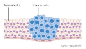 Cáncer - Carcinoma de células escamosas.