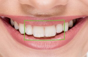 Los incisivos son los 4 dientes anteriores y sirven para cortar