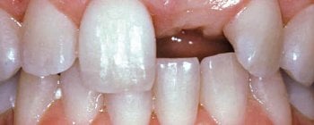 Agenesia dental