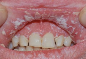 encías blancas por candidiasis