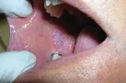 placa blanca por hiperqueratosis