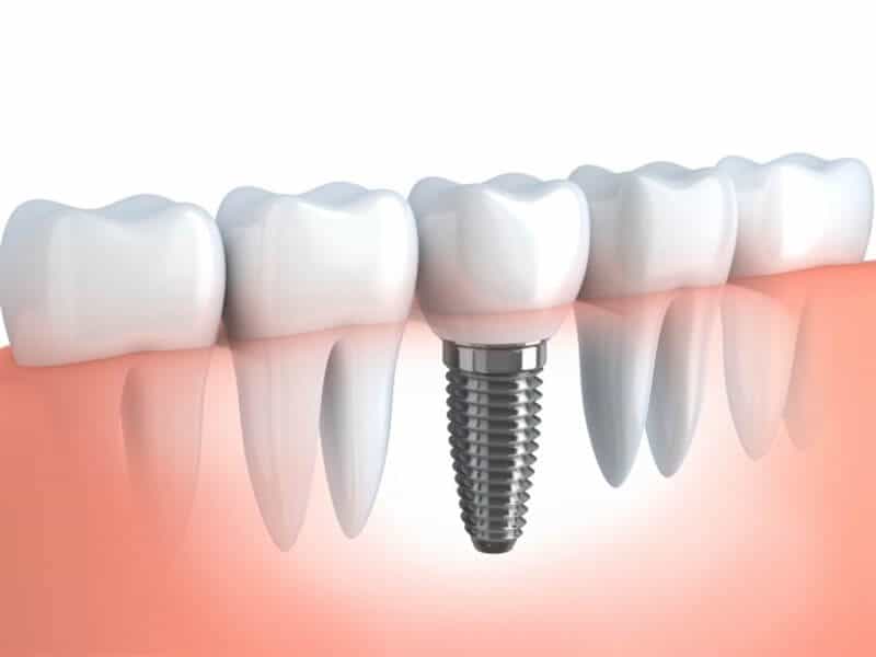 implante dental en Turquía