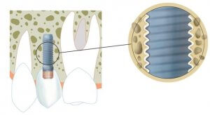 osteointegración de un implante dental