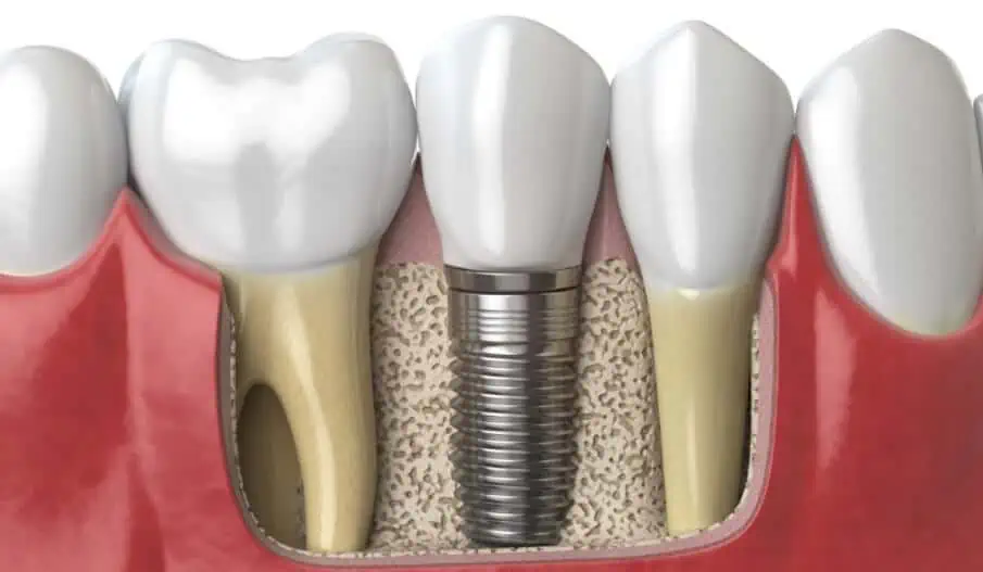 osteointegración de un implantes dentales