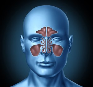 Sinusitis - Inflamación de los senos paranasales