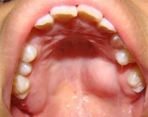 Tumores benignos de las glándulas salivales