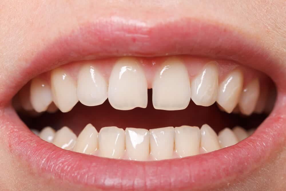 diastema interincisivo