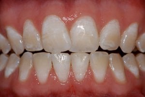 Fluorosis dental