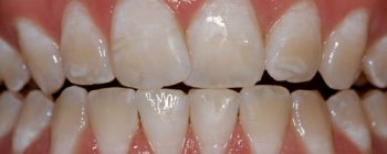 Hipoplasia dental