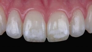 Fluorosis leve