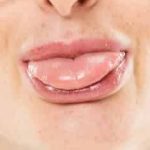 52671Absceso dental: causas, síntomas y cómo curar un flemón