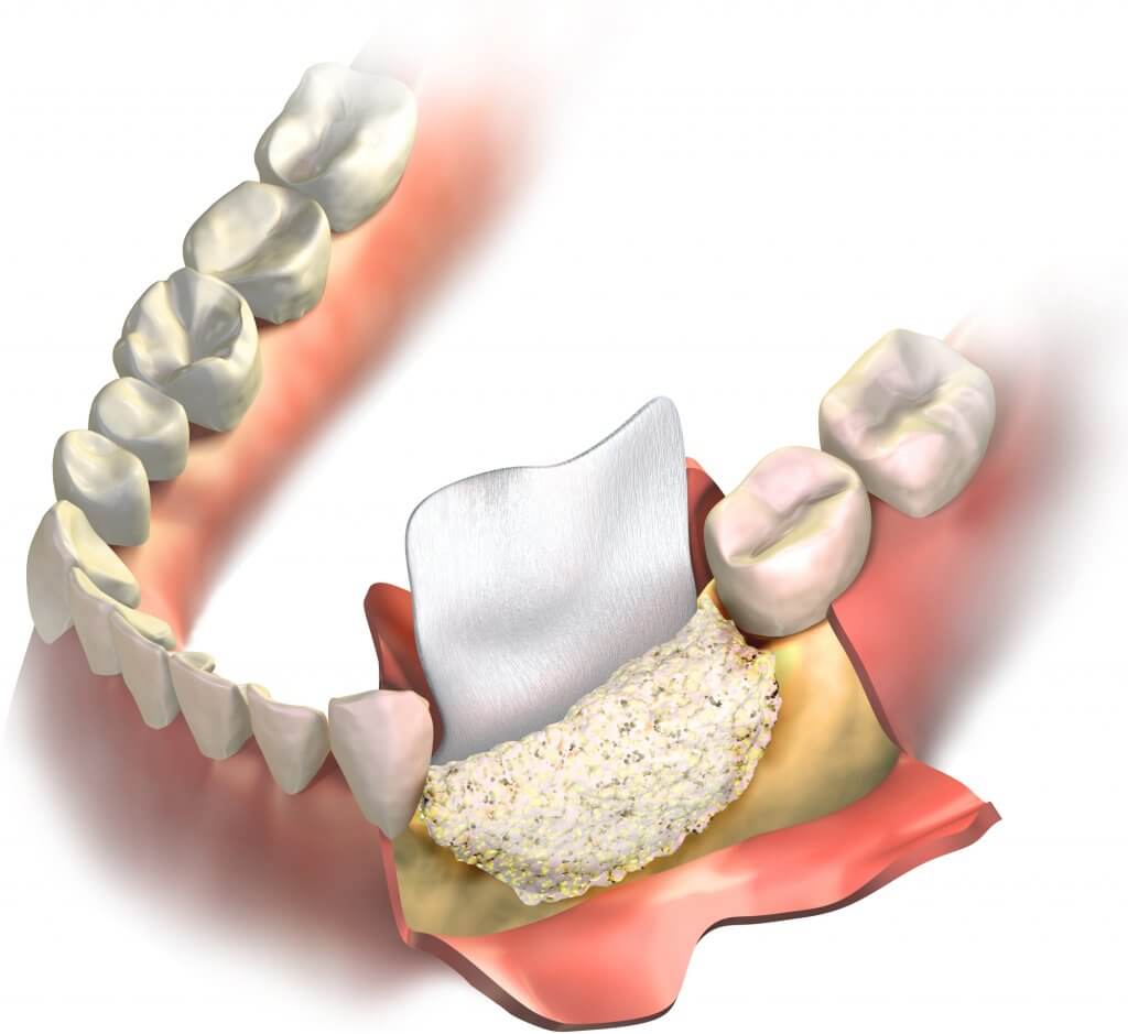 recreación de injerto de hueso dental