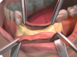 Ilustración de un injerto óseo dental