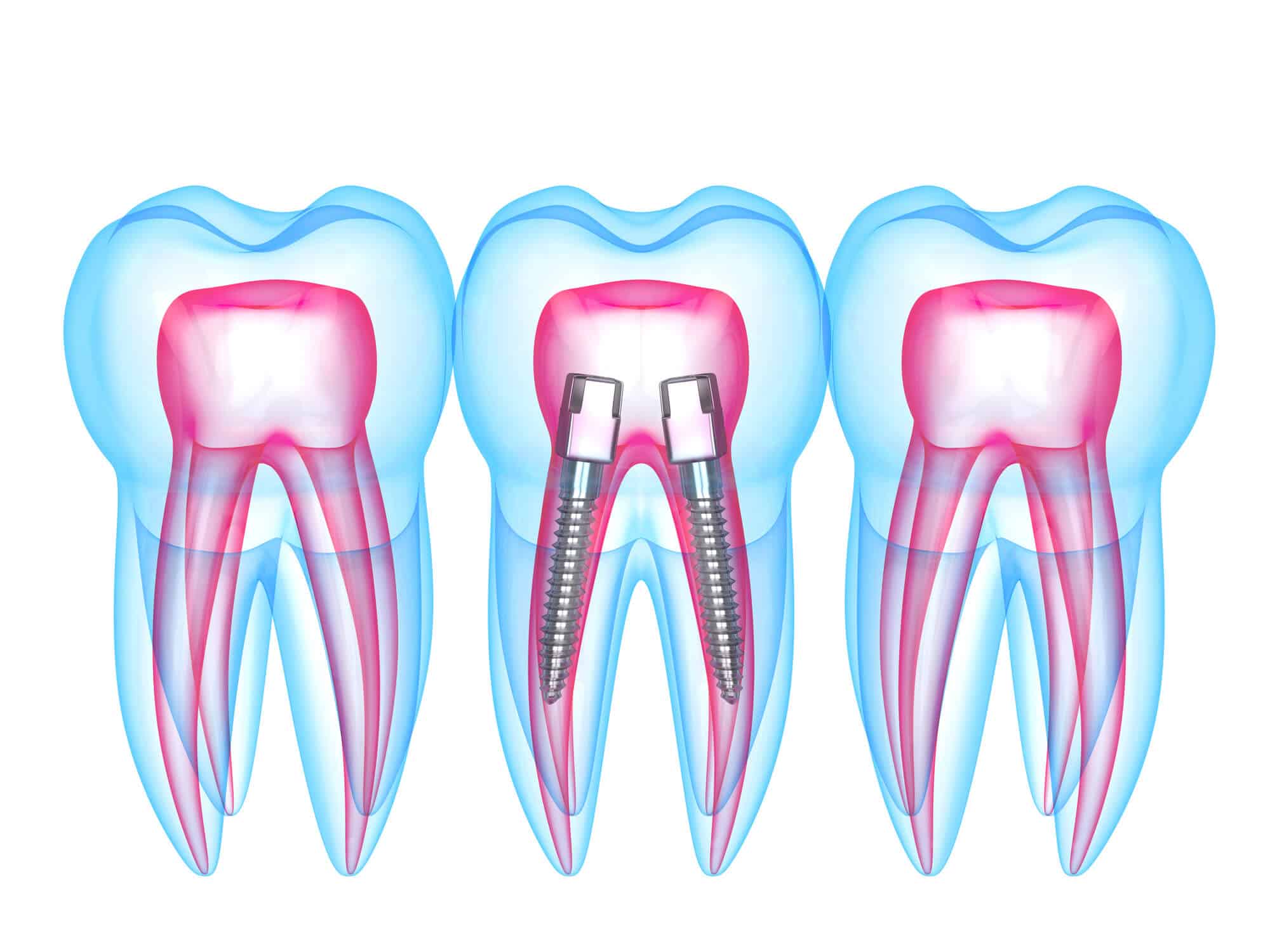 Qué es un perno dental, beneficios y su precio en España
