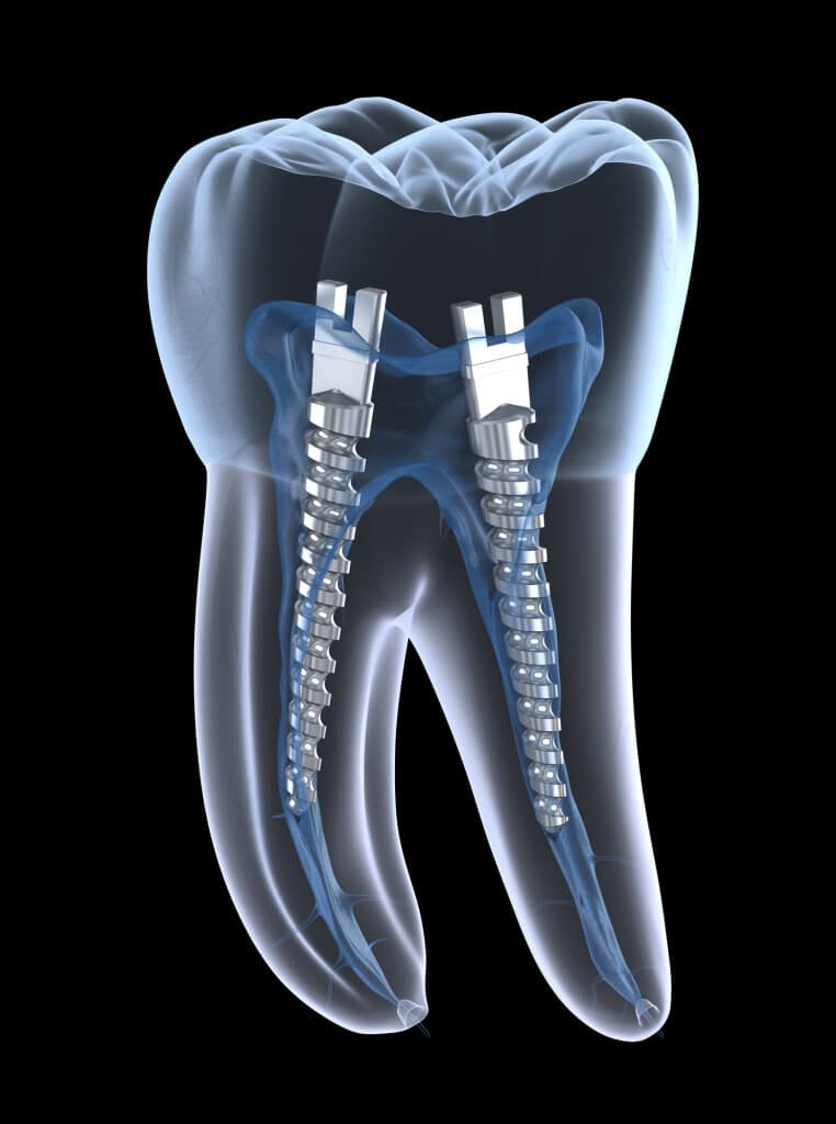 imagen de Perno dental