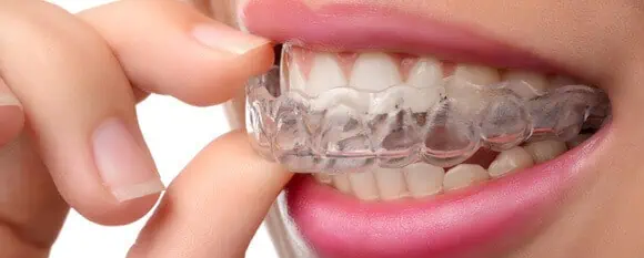 precio de Invisalign en España