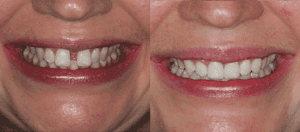 Invisalign antes y después