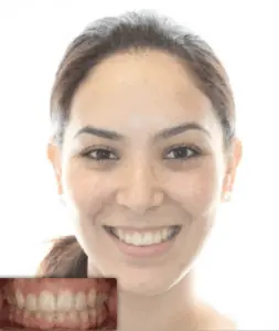 Ortodoncia antes y después de Invisalign