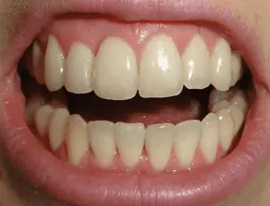 Invisalign fotos antes y después apiñamiento dental