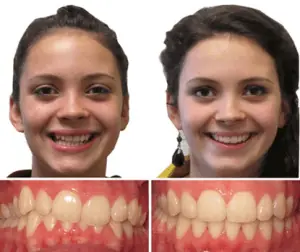 Invisalign antes y después