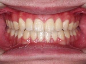 El antes y después de Invisalign: fotos y resultados de casos reales