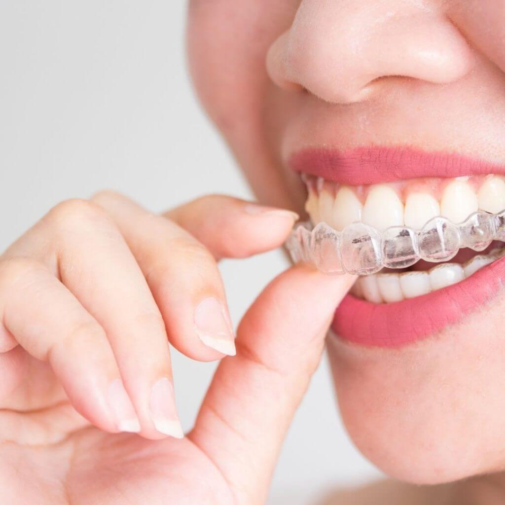 qué es invisalign refinamiento