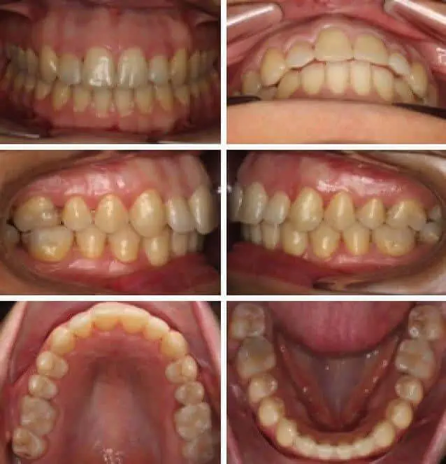 Brackets cerámicos antes y después