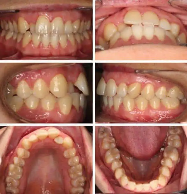 Brackets cerámicos antes y después