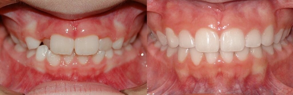 dientes torcidos antes y despues brackets