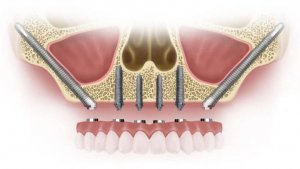 implantes dentales sin hueso