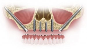 implantes dentales sin hueso precios 