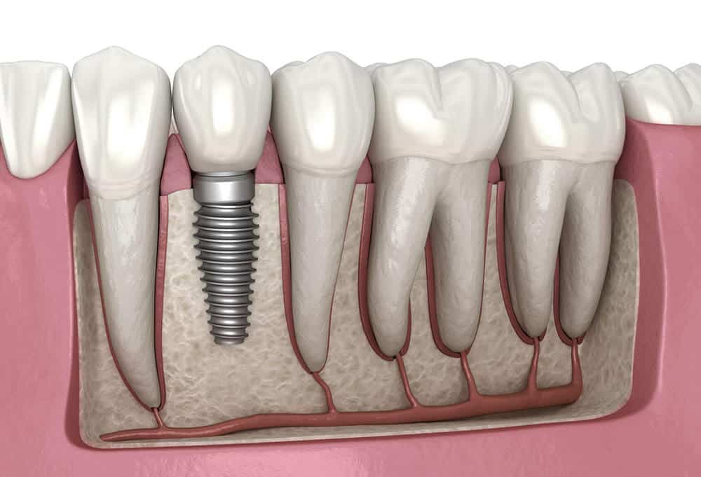 Ilustración implante dental sin hueso