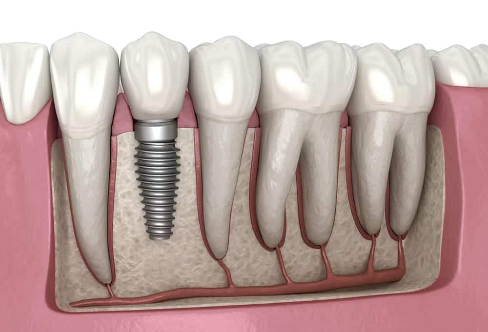 poner muela sin implantes dentales sin hueso 