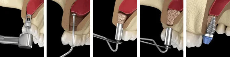 implantes dentales con poco hueso  