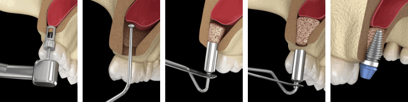Proceso de colocación de implantes dentales con poco hueso